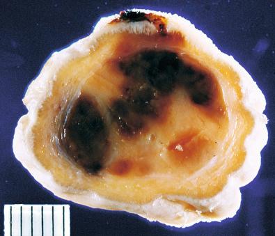 Fig. 20.20, Gross appearance of subcutaneous epithelioid hemangioma.