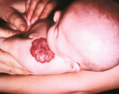 Fig. 20.2, Clinical appearance of infantile hemangioma.