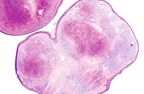 Fig. 20.21, Low-power view of epithelioid hemangioma with nodules of vessels surrounded by prominent lymphoid cuff.