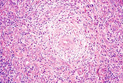 Fig. 20.22, Epithelioid hemangioma with central parent vessel surrounded by small vessels and dense inflammation.