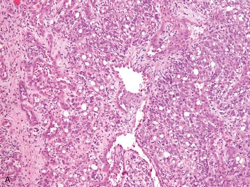 Fig. 20.23, Epithelioid hemangioma of soft tissue illustrating the lobular pattern of growth with central vessel ( A ) surrounded by cloud of capillary vessels ( B ).