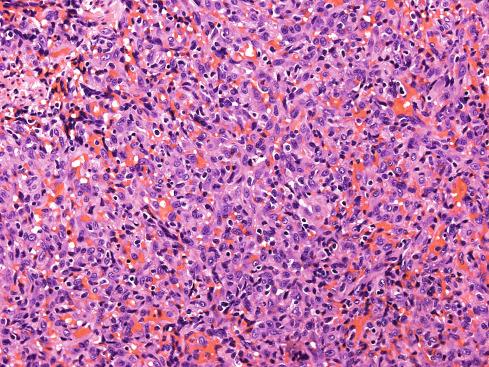 Fig. 20.25, Solid form of epithelioid hemangioma with subtle luminal differentiation and intralesional hemorrhage.