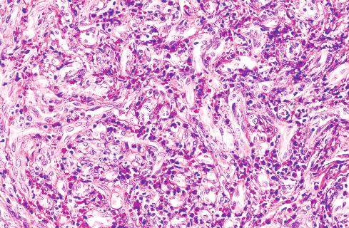 Fig. 20.27, Epithelioid Hemangioma.