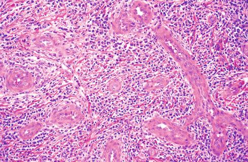 Fig. 20.28, Epithelioid hemangioma in which some areas display more conventional-appearing endothelial cells interspersed with chronic inflammatory cells.