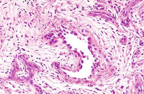 Fig. 20.29, Tombstone-like appearance of cells in large vessels of epithelioid hemangioma.