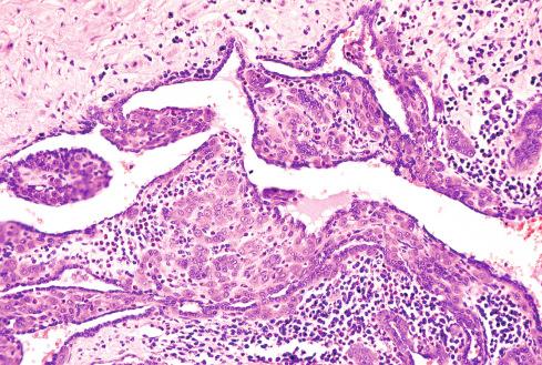 Fig. 20.30, Epithelioid hemangioma involving wall of large vessel. This phenomenon should not be equated with malignancy.