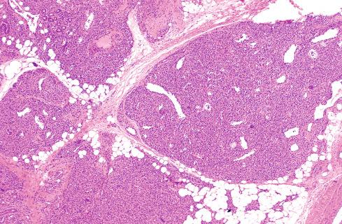 Fig. 20.3, Low-power view of infantile hemangioma illustrating lobular growth. Lobules contain central feeding vessels.