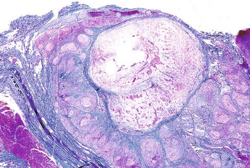 Fig. 20.31, Epithelioid hemangioma arising from wall of traumatized vessel. Note prominent lymphocytic infiltrate around the lesions.