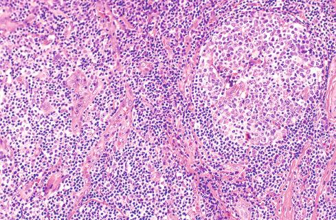 Fig. 20.32, Kimura Disease.