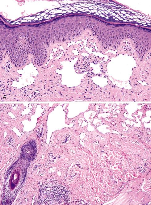 Fig. 20.34, Hobnail hemangioma (targetoid hemosiderotic hemangioma) showing ectatic vessels at the surface ( A ) and in deeper regions, illustrating interface of ectatic vessels with attenuated slitlike vessels ( B ).