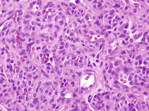 Fig. 20.4, Infantile hemangioma, proliferative phase, with capillaries having plump endothelium and pericytes and only minor canalization.