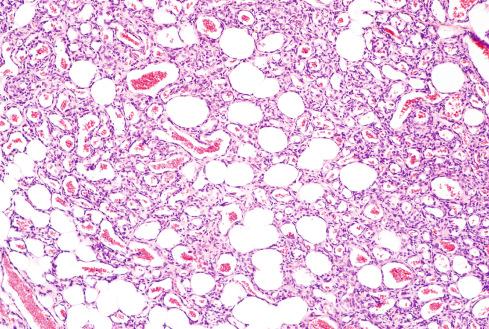 Fig. 20.5, Infantile hemangioma showing canalization of most vessels, larger lumens, and flattened endothelial cells.