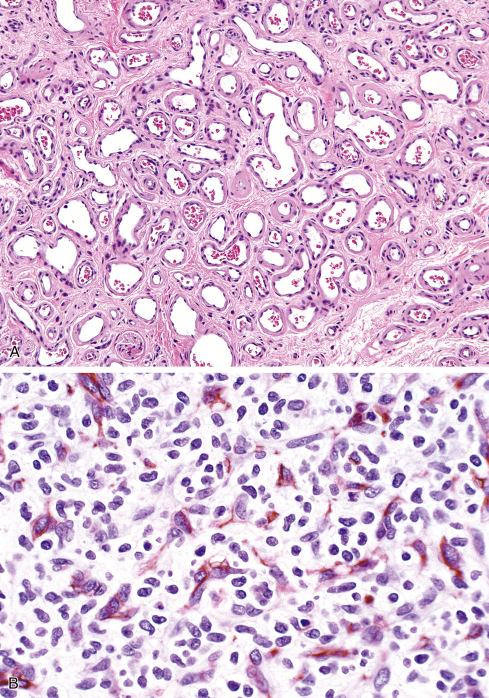 Fig. 20.6, A, Infantile hemangioma, involutive phase, with capillaries having wide lumens, thickened basement membranes, and separation by fibrous tissue. B, Immunostain for von Willebrand factor illustrates network of mature endothelial cells. Note the population of nonreactive cells representing a combination of immature endothelial cells and pericytes. C, GLUT1 immunostaining within infantile hemangioma showing endothelial and erythrocyte staining.