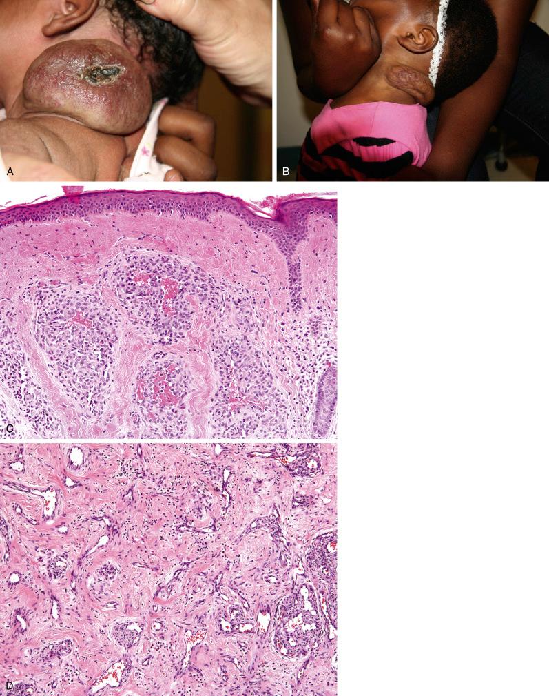 Fig. 20.7, A, Rapidly involuting congenital hemangioma presenting in 2-week-old infant as large cervical mass with cutaneous telangiectasias, dilated veins, and central depression with ulceration. B, Marked involution by 1 year of age. C, Small dermal lobules with enlarged central channels and only minimally prominent endothelium. D, Zone with “vanishing” lobules, residual draining channels, and fibrous tissue. E, Noninvoluting congenital hemangioma in 2-year-old boy presenting as flattened, dome-shaped lesion with telangiectasias, unchanged since birth. F, Dermal lobules of varying size and shape and prominent intra- and interlobular arteries and veins. G, Lobule showing thin-walled peripheral capillaries with hobnailed endothelium, centrilobular fibrosis with large channels, and prominent interlobular vessels with thick walls. H, Endothelial cytoplasmic eosinophilic inclusions.