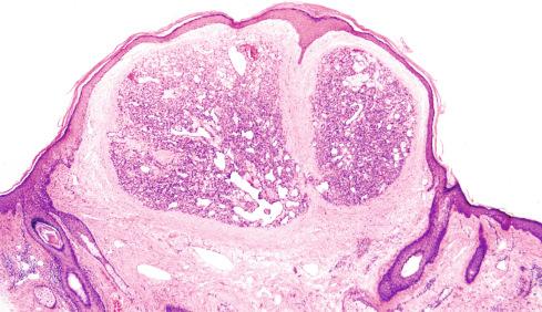 Fig. 20.8, Pyogenic granuloma with exophytic growth.