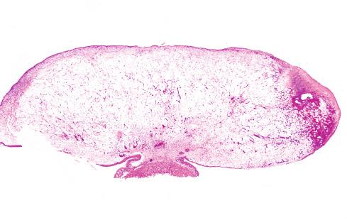 Fig. 20.10, Pyogenic granuloma with ulceration of surface and marked stromal edema.