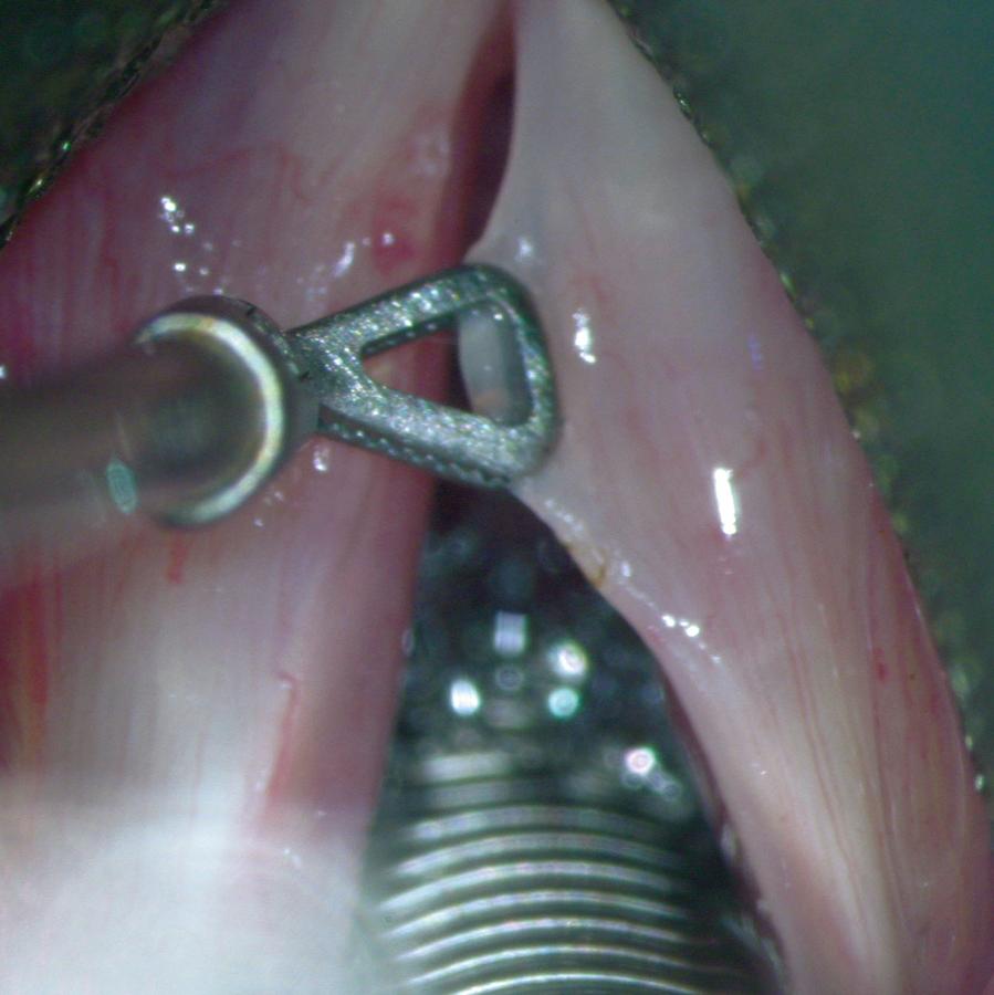Fig. 60.2, Gentle medial retraction shows the relative decoupling of the mucosa from the underlying nondeformed vocal ligament.