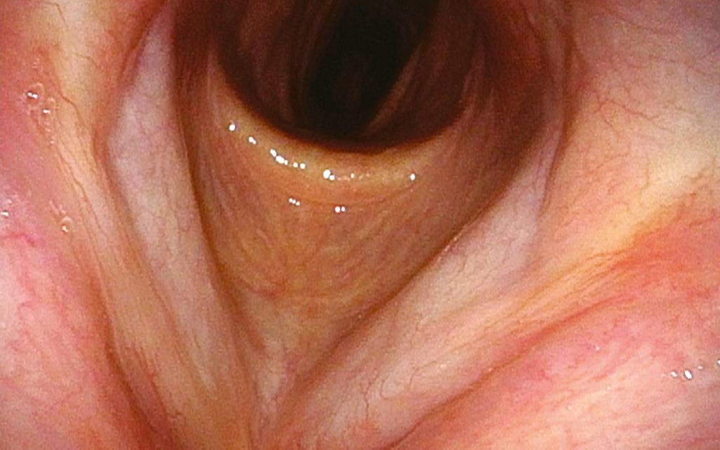 Fig. 60.5, Extreme closeup of the larynx with adequate resolution of the vocal folds, subglottis, and even high trachea.