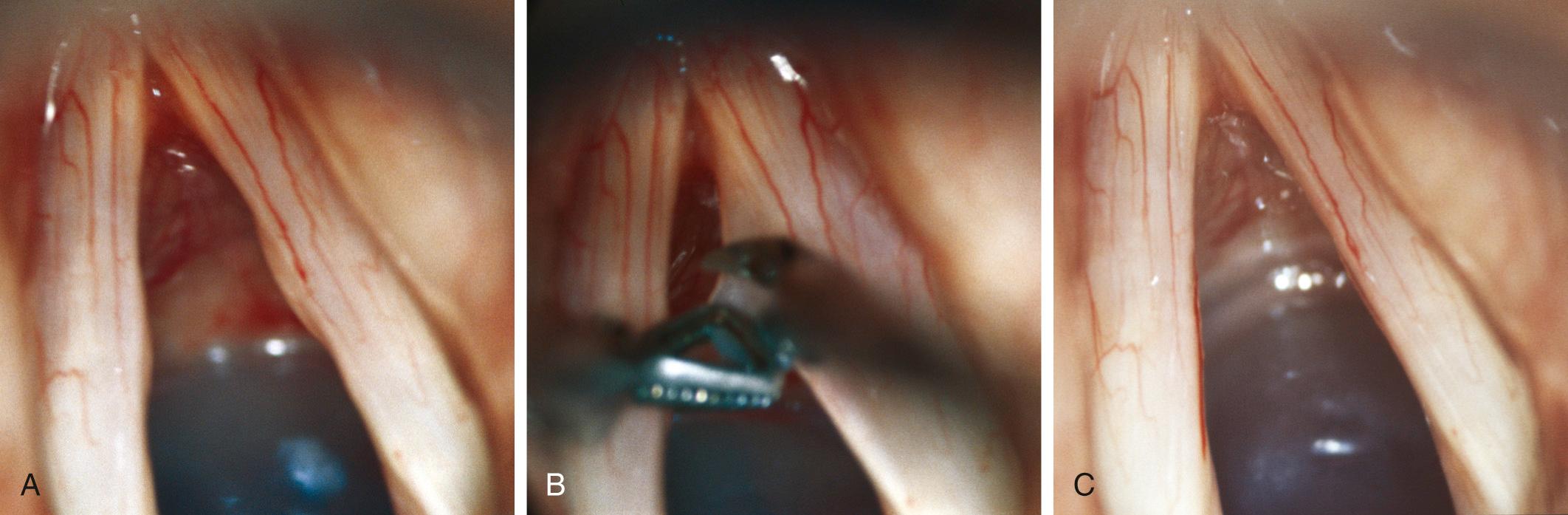 Fig. 60.8, The operative sequence in a professional actress specializing in musical theater who, for more than 2 years, had been experiencing vocal symptoms and limitations compatible with fusiform vocal nodules. (A) The operative view after many months of conservative management. Not all fusiform swellings are reversible with conservative measures alone. (B) A polypoid nodule is grasped superficially and tented medially with Bouchayer forceps. Scissors that curve away from the vocal fold are used for removal. The nodule is thus removed in a very superficial plane, which minimizes the risk of scar between the remaining and regenerated mucosa and the underlying vocal ligament. (C) Vocal fold appearance after excision. The patient experienced dramatic normalization of her vocal capabilities, and no evidence of scarring was found on postoperative stroboscopic examination. The dilated capillaries may predispose to recurrent nodule formation and can be spot-coagulated with a microspot laser.