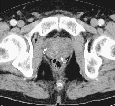 Figure 73-1, Axial contrast-enhanced computed tomography image of the prostate in a patient with acute bacterial prostatitis. Note the enlarged gland with areas of low attenuation (arrows).