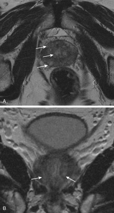 Figure 73-2, Axial (A) and coronal (B) T2-weighted magnetic resonance images of the prostate in a patient with bacterial prostatitis show multifocal areas of increased signal intensity (arrows) consistent with prostatitis.