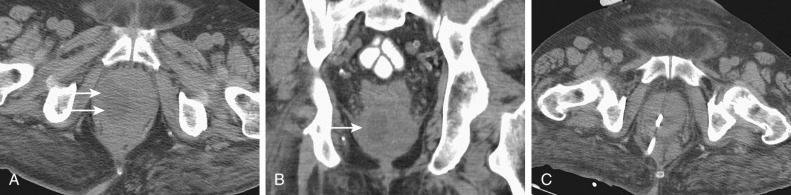 Figure 73-3, Axial (A) and coronal (B) computed tomography images demonstrate a right-sided hypodense collection that is slightly irregular in outline ( arrows, A ). The prostate gland is mildly enlarged on the right side ( arrow, B ). These findings are consistent with a prostate abscess that was subsequently successfully treated with a combination of antibiotics and percutaneous interventional radiology catheter drainage (C).