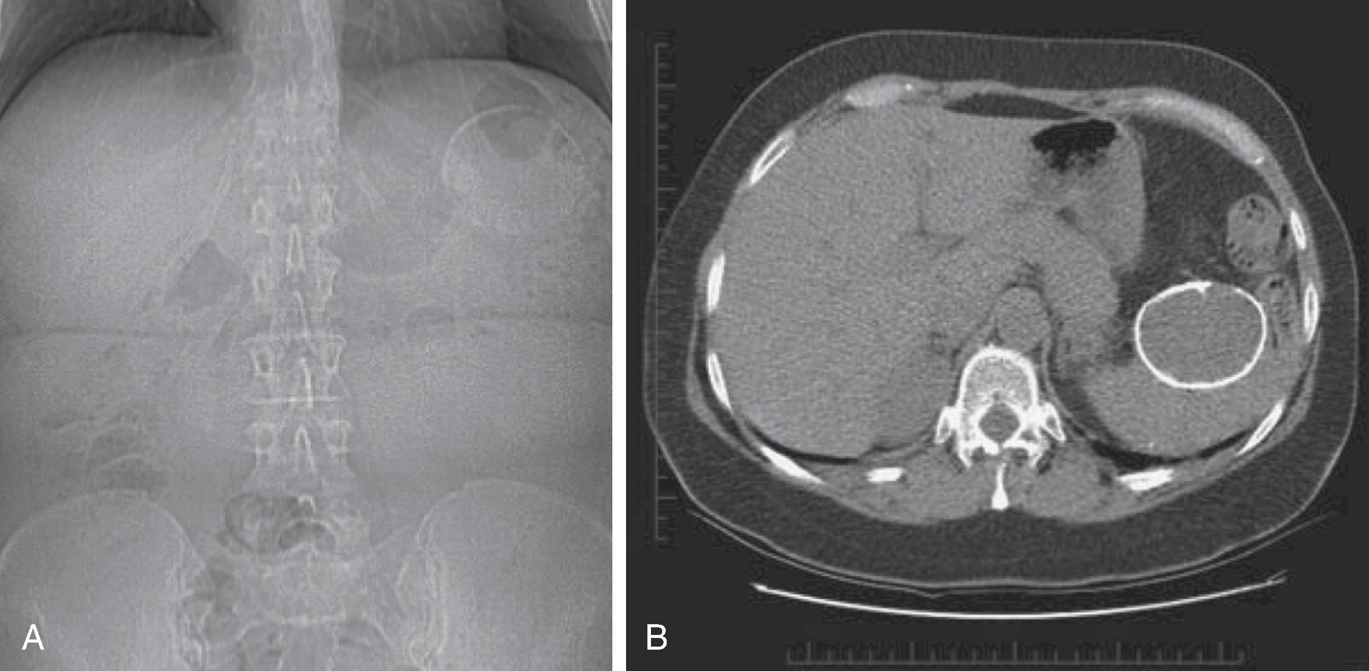 Fig. 62.2, Pseudocyst.