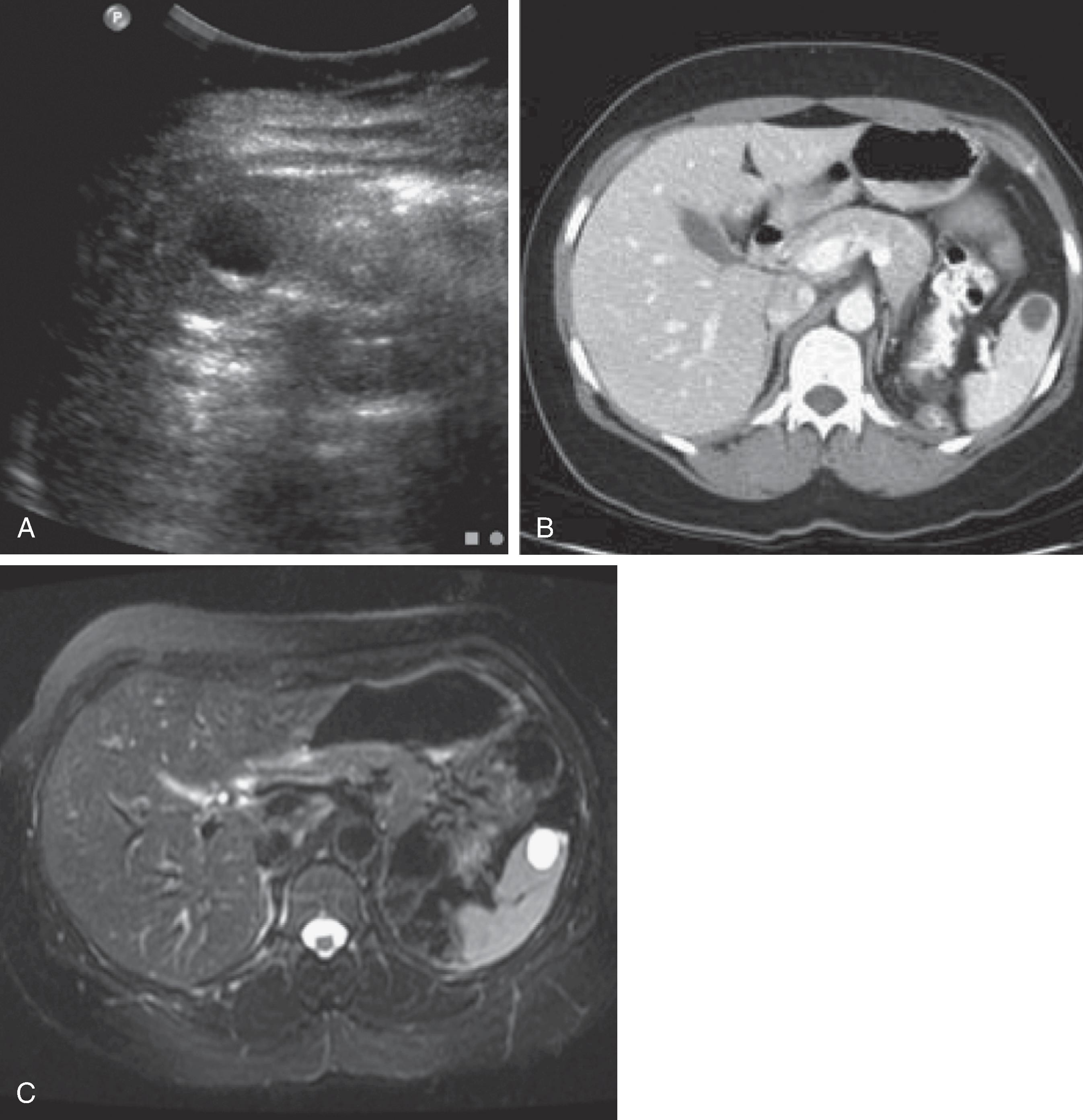 Fig. 62.3, Congenital cyst: small, simple asymptomatic cyst in a young female patient.