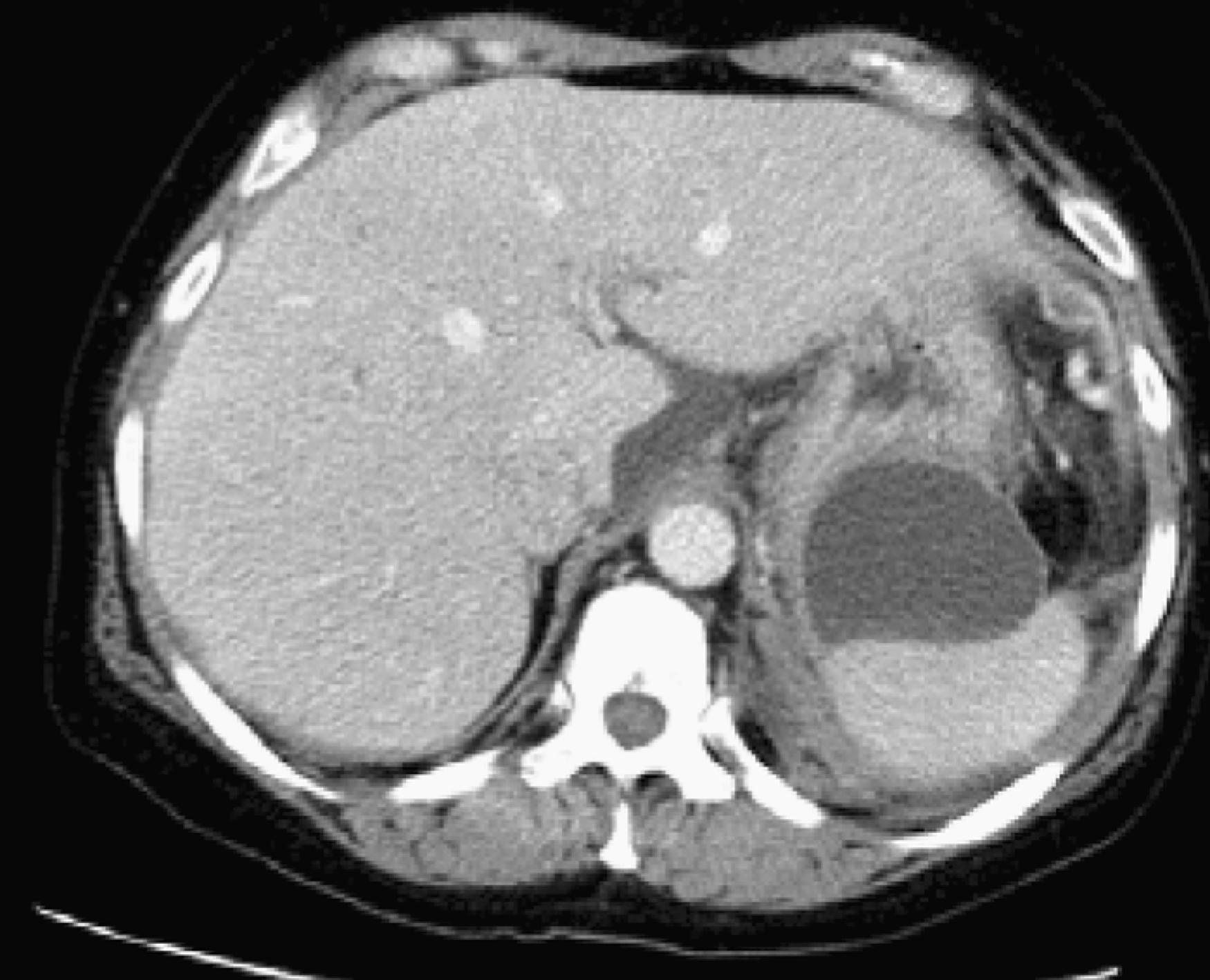 Fig. 62.4, Pancreatic pseudocyst.