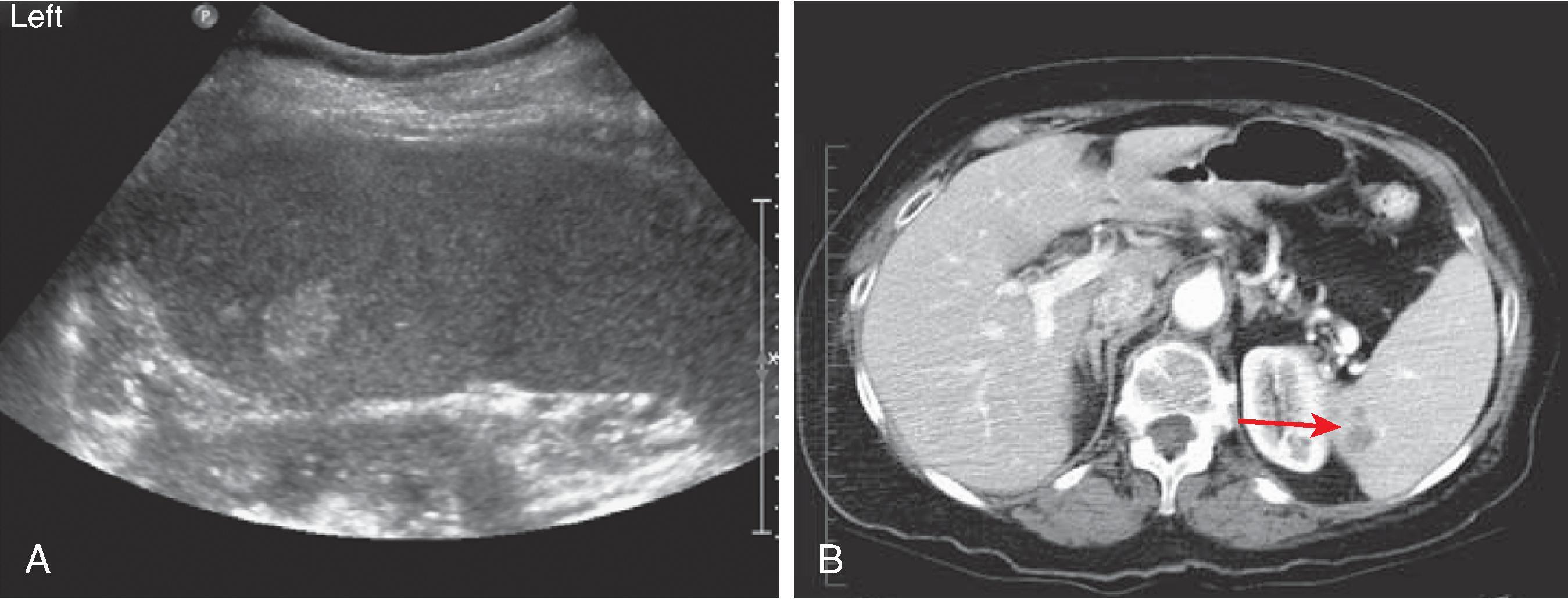 Fig. 62.5, Splenic hemangioma.