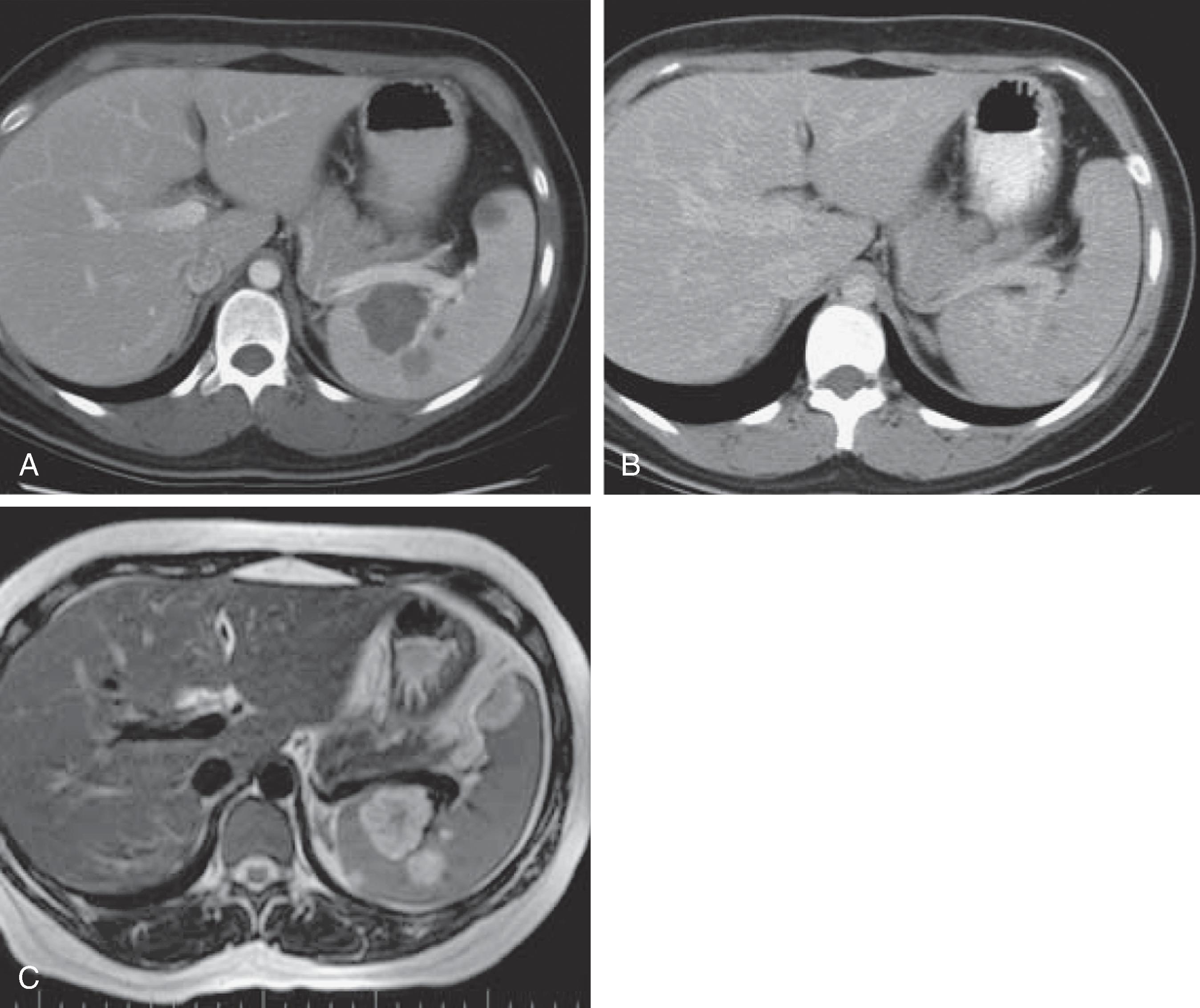 Fig. 62.6, Multiple splenic hemangiomas.