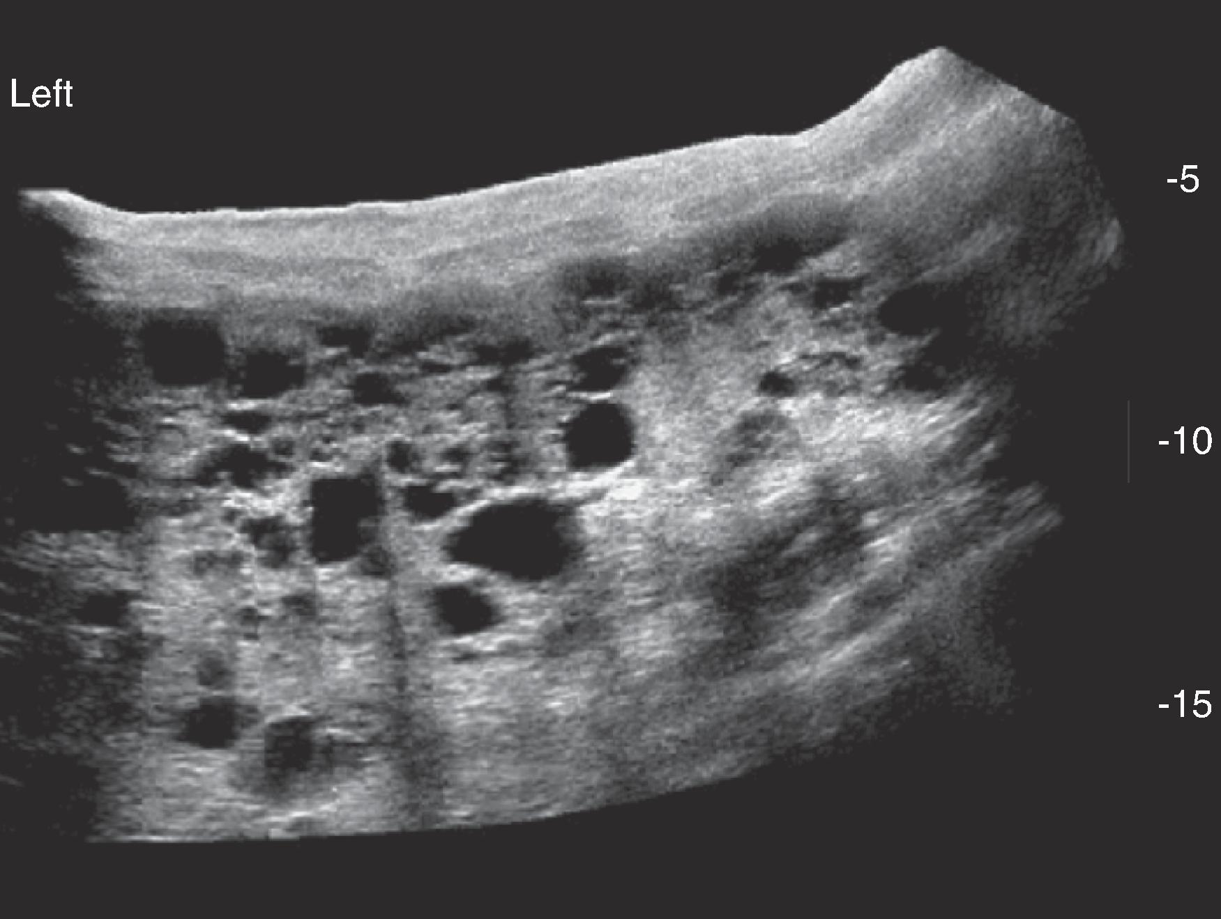 Fig. 62.7, Lymphangiomatosis in a young female patient involving multiple organs, including the spleen.