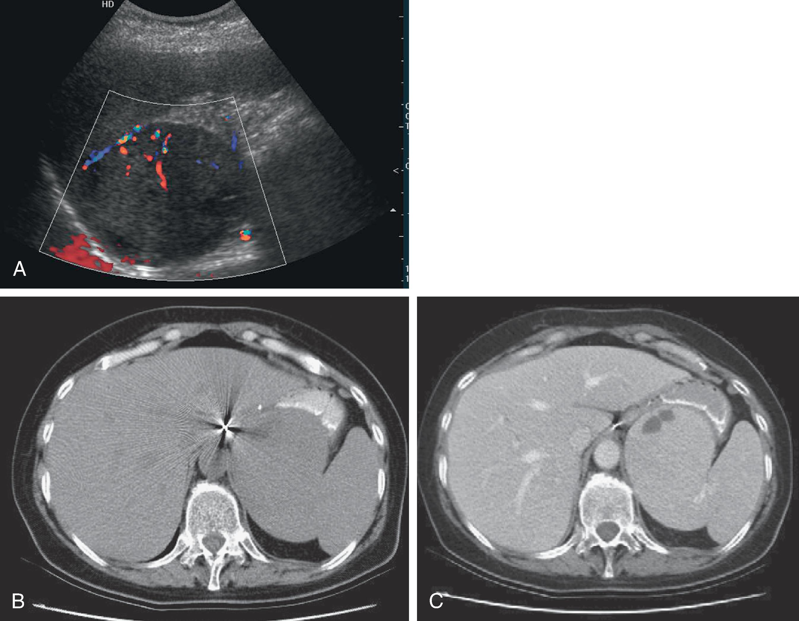 Fig. 62.8, Hamartoma.