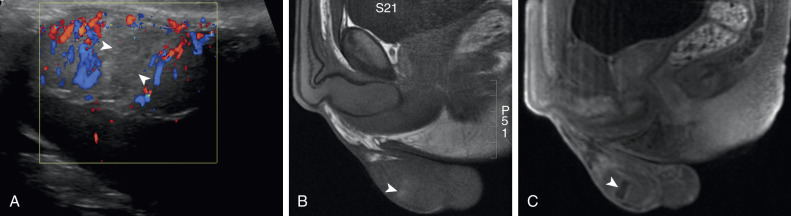 Figure 78-1, Segmental testicular infarction. A, Color Doppler ultrasound image in a 24-year-old man with acute onset of scrotal pain shows a focal area of hypovascularity (arrowheads) surrounded by areas of normal vascularity. B, On magnetic resonance (MR), this area is T1 hyperintense (arrowhead) relative to the normal testicular parenchyma. C, Postcontrast sagittal T1-weighted MR image shows a well-defined focal perfusion defect (arrowhead), confirming the diagnosis of segmental testicular infarction.