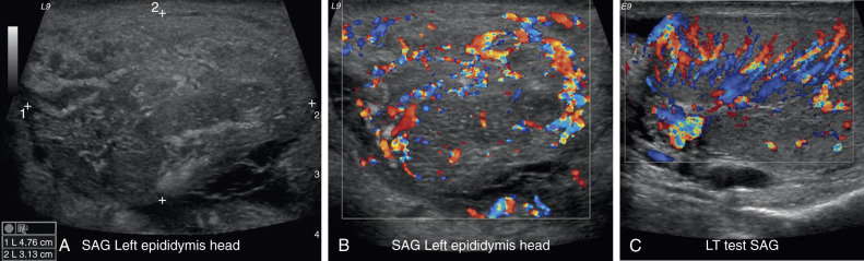 Figure 78-4, Epididymo-orchitis. A 61-year-old man with scrotal pain. A, Sagittal gray-scale ultrasound image demonstrates a markedly enlarged heterogeneous epididymal head. B, Color Doppler image shows increased vascularity in the enlarged epididymal head. C, Transverse image of the testis demonstrates marked testicular hyperemia.