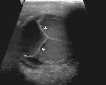 Figure 78-6, Scrotal hematocele. Transverse image of a testis with adjacent multiseptated collection (arrowheads) with internal echoes. Surgery confirmed an organizing chronic scrotal hematoma.