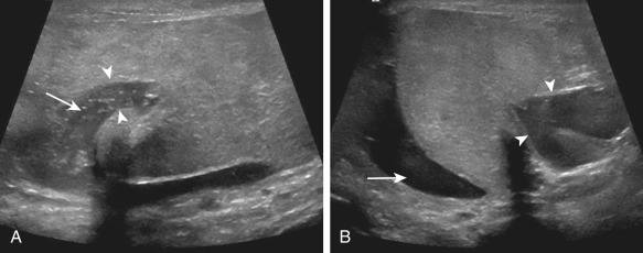 Figure 78-7, Testicular fracture. A, A young man presented with an enlarging scrotum after a severe motor vehicle accident. Sagittal gray-scale ultrasound image of the testis shows rupture of the tunica albuginea (arrowheads) with seminiferous tubules spilling out into the scrotal sac (arrow). B, Transverse image of the same testis shows the break in the tunica albuginea (arrowheads) with a hematocele (arrow).