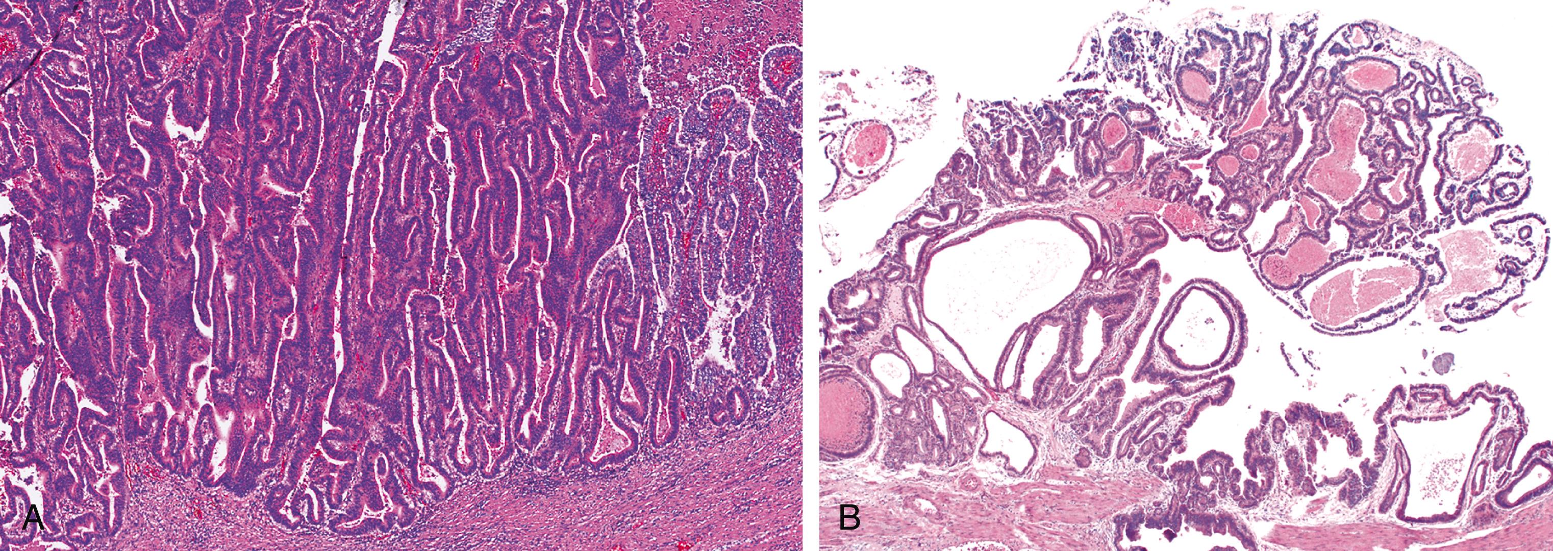 FIGURE 39.2, Intracholecystic papillary-tubular neoplasms are characterized by intraluminal growth of back-to-back epithelial units, either in a papillary (A) or tubular (B) configuration or both, with minimal or no intervening stroma.