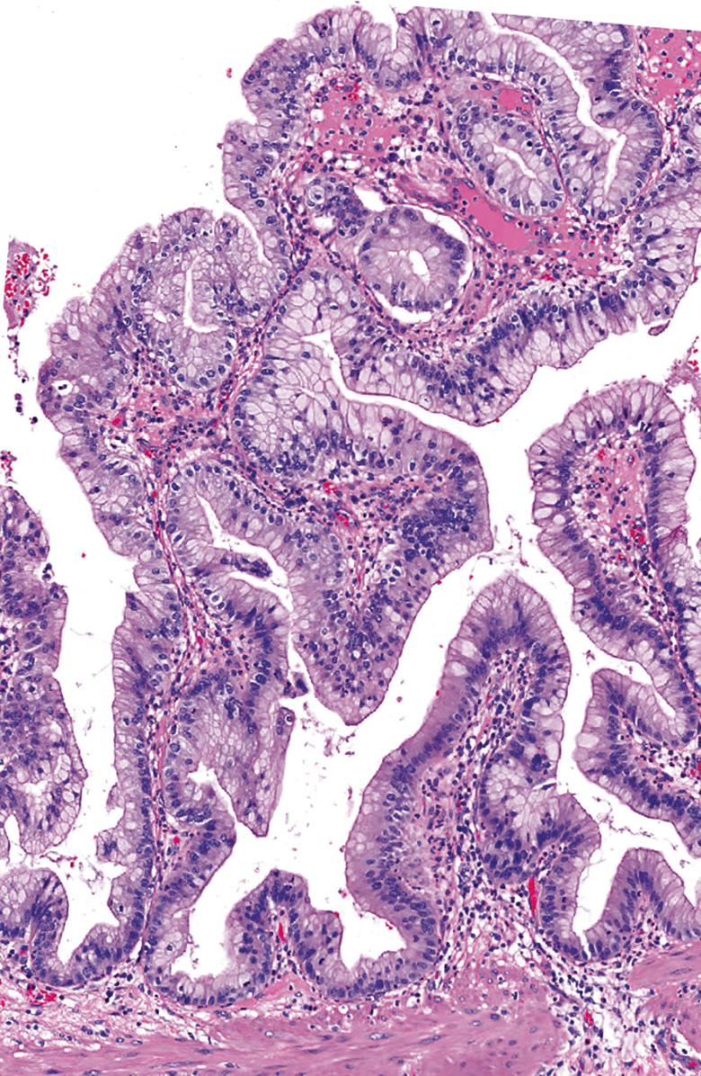 FIGURE 39.3, Intracholecystic papillary-tubular neoplasms with low-grade dysplasia reveal subtle cytoarchitectural changes. The nuclei are still small, relatively uniform, and mostly confined to the lower aspect of the epithelium.