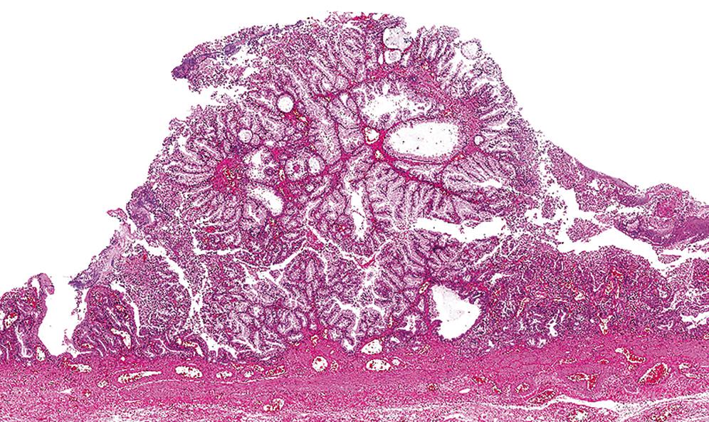 FIGURE 39.7, The gastric foveolar phenotype in intracholecystic papillary-tubular neoplasm is characterized by ill-formed papillae or elongated, interconnecting tubules lined by tall columnar cells with abundant pale mucin.