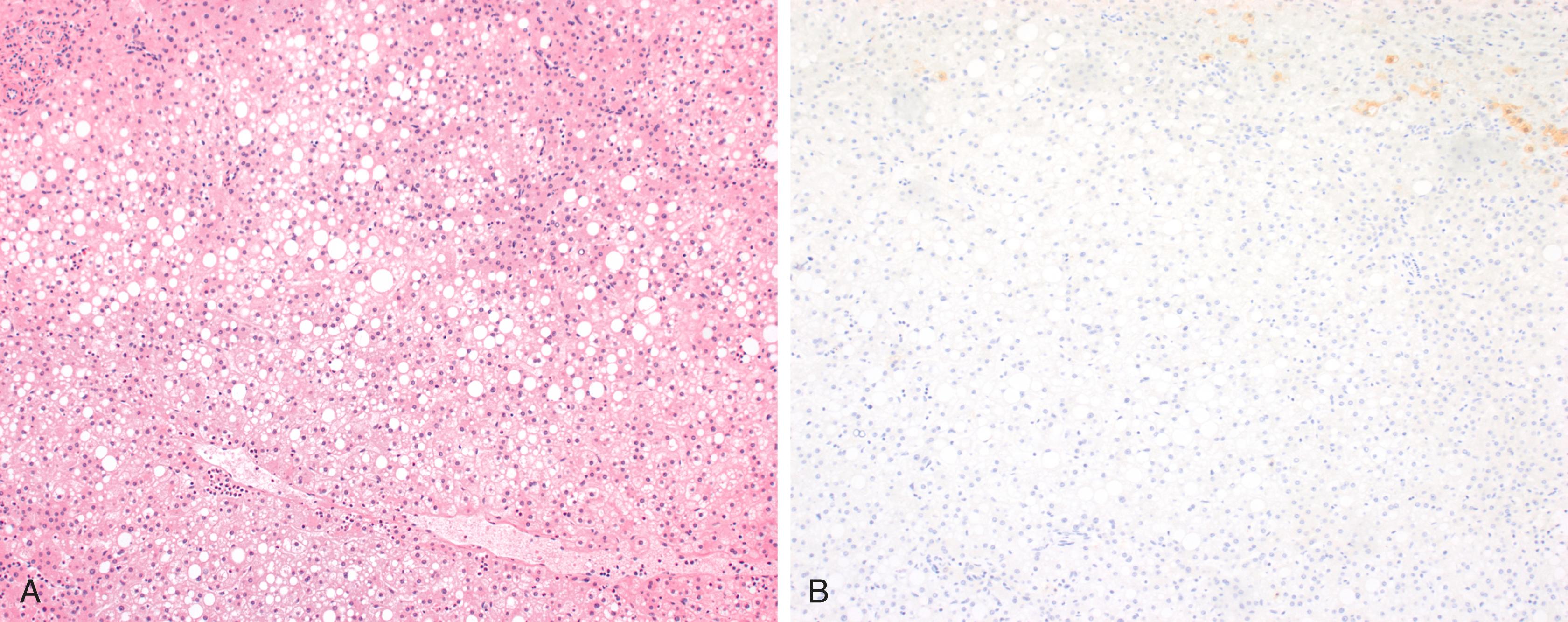 FIGURE 56.3, HNF1α –inactivated HCA (H-HCA) characterized by prominent intralesional steatosis.