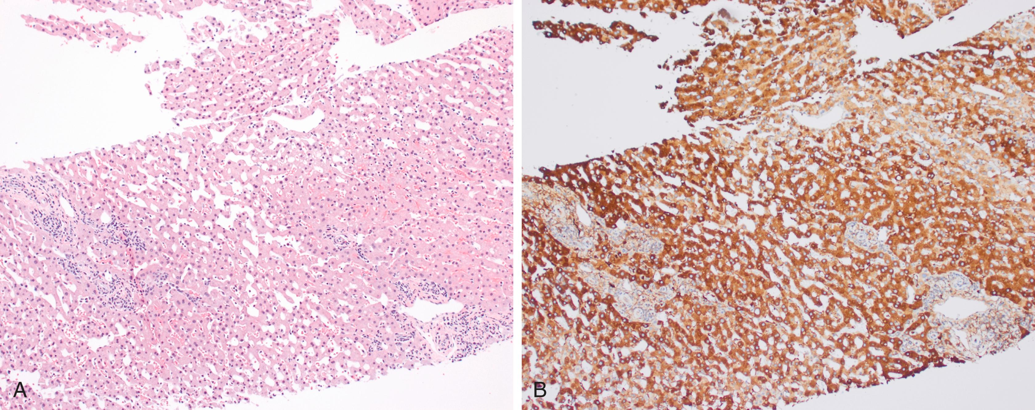 FIGURE 56.4, Inflammatory hepatocellular adenoma characterized by sinusoidal dilation and mild ductular reaction (A). The lesional hepatocytes show diffuse staining with C-reactive protein (B).