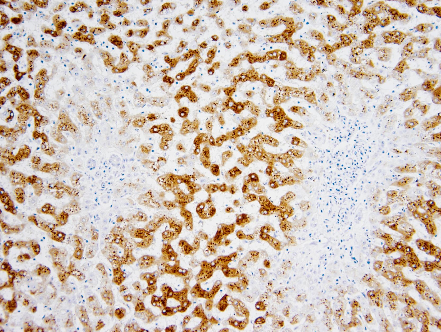 FIGURE 56.5, Diffuse granular cytoplasmic staining with serum amyloid A in inflammatory HCA.