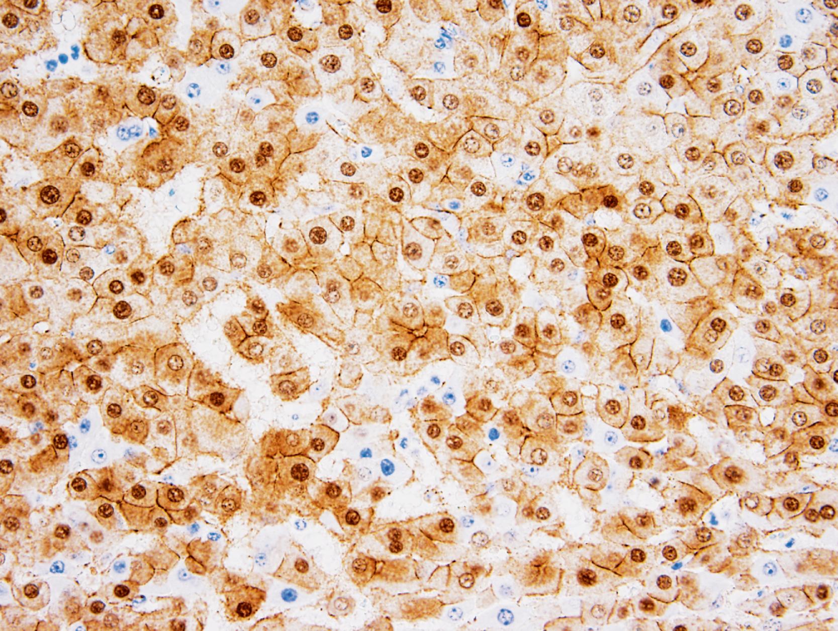 FIGURE 56.7, Positive nuclear staining with β-catenin immunohistochemistry indicates the presence of β-catenin activation.