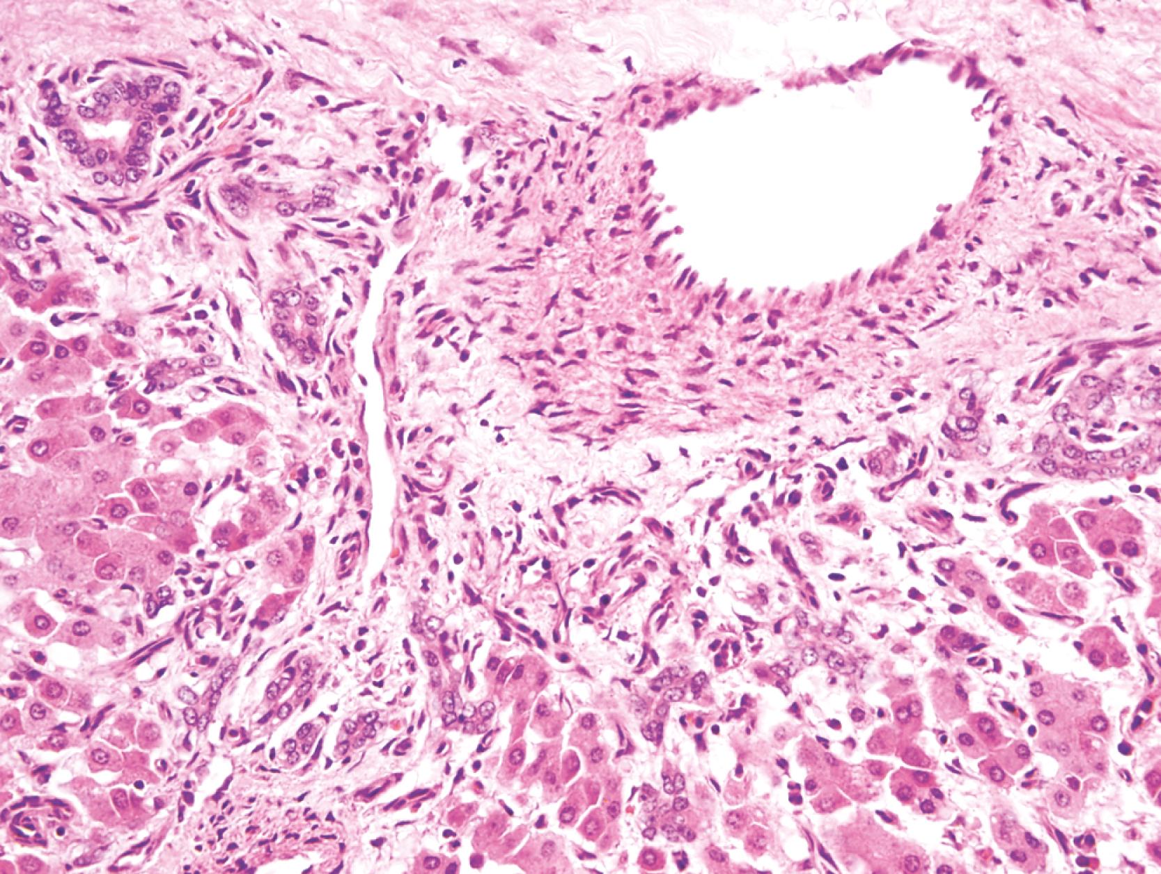 FIGURE 56.10, Focal nodular hyperplasia with aberrant thick-walled artery and ductular reaction that typically occurs at the junction of the stroma and parenchymal nodules.