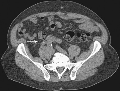 Figure 67-1, Noncontrast axial computed tomography image in a patient with flank pain shows soft tissue thickening surrounding a ureteral calculus (arrow), the soft tissue rim sign.