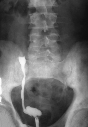 Figure 67-2, Retrograde urography in a patient with transitional cell carcinoma of the ureter shows dilation of the ureter below the lesion, the goblet sign.