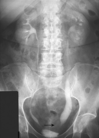 Figure 67-3, Excretory urography in a patient with primary megaureter shows dilatation of the ureter proximal to the normal-caliber aperistaltic segment (arrow).