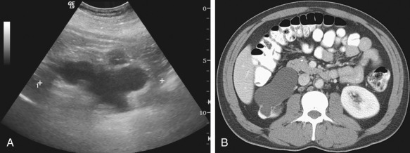 Figure 67-4, Ultrasound (A) and axial contrast-enhanced computed tomography (B) images in a patient with chronic right ureteropelvic junction obstruction show right hydronephrosis and renal parenchymal atrophy.