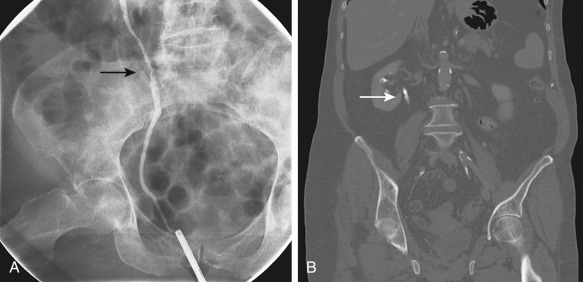 Figure 67-5, Retrograde pyelogram (A) and coronal reconstructed computed tomography image (B) in a 78-year-old man with hematuria show multiple filling defects (arrows) consistent with pyeloureteritis cystica.